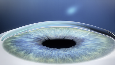 Applying Mitomycin-C to prevent corneal haze in LASEK step 3