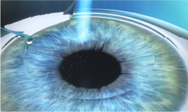 Laser reshaping of the cornea to correct vision in LASEK step 2