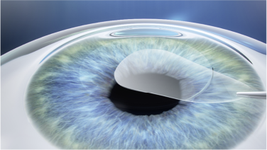 Laser reshaping of the cornea to correct vision in LASEK step 2