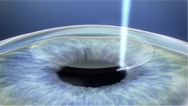 Carefully removing the corneal epithelium in LASEK step 1