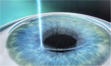 Carefully removing the corneal epithelium in LASEK step 1
