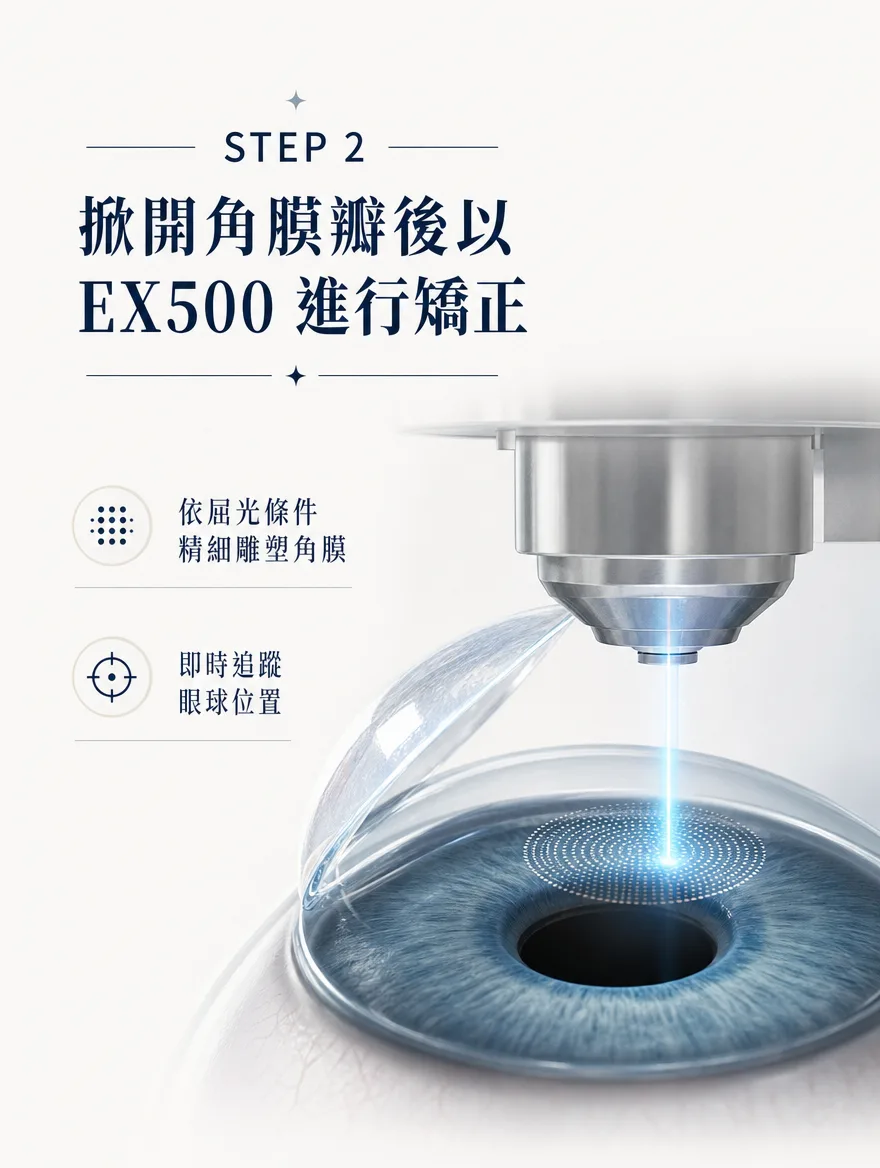 全雷射LASIK — 掀開角膜瓣後以 EX500 進行矯正 — 依屈光條件精細雕塑角膜，並即時追蹤眼球位置。