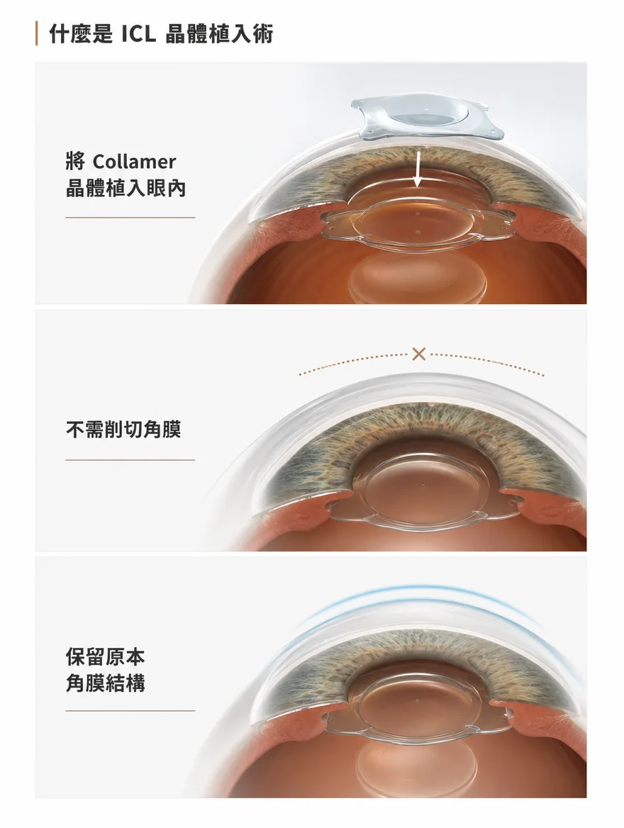眼內鏡片植入術(ICL) — 什麼是 ICL 晶體植入術 — 將 Collamer 材質的晶體植入眼內,不需削切角膜,保留原本角膜結構。