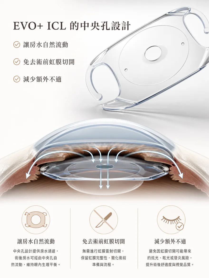 眼內鏡片植入術(ICL) — EVO+ ICL 的中央孔設計 — 中央孔設計提供房水通道,術後房水可經由中央孔自然流動,維持眼內生理平衡;無需進行虹膜雷射切開,保留虹膜完整性;避免因虹膜切開可能帶來的炫光、眩光或發炎風險,提升術後舒適度與視覺品質。