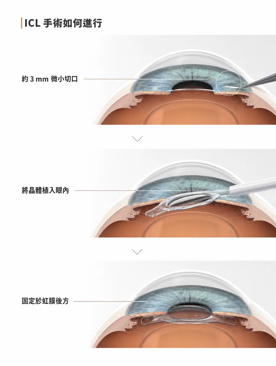 眼內鏡片植入術(ICL) — ICL 手術如何進行 — 透過約 3mm 的微小切口,將晶體植入眼內,並固定於虹膜後方。