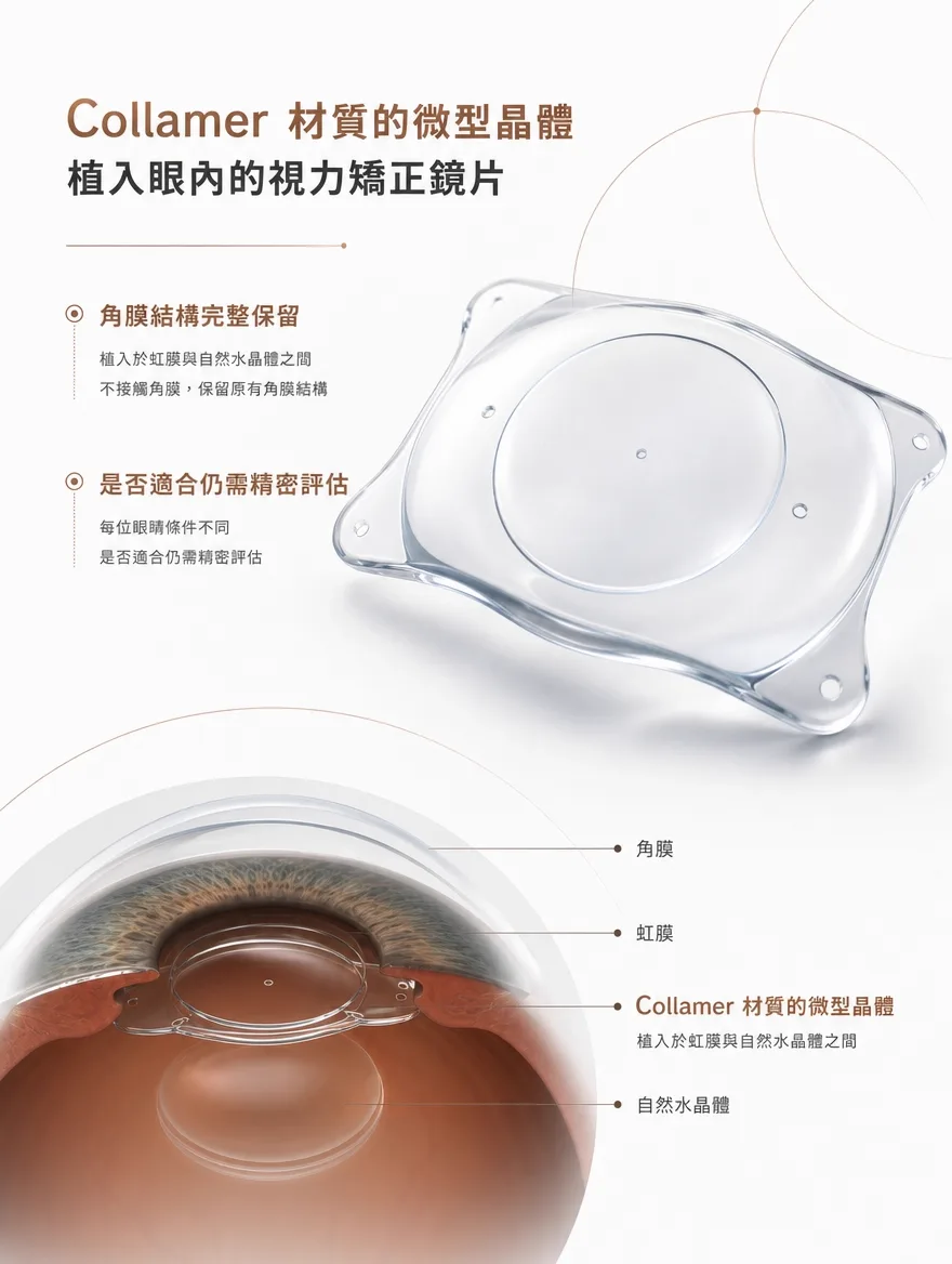 眼內鏡片植入術(ICL) — Collamer 材質的微型晶體 — 植入於虹膜與自然水晶體之間,不接觸角膜,保留原有角膜結構。每位眼睛條件不同,是否適合仍需精密評估。
