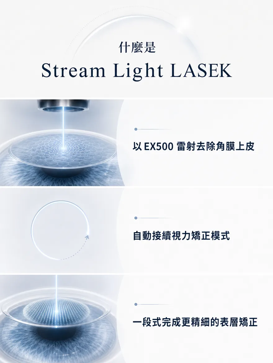 StreamLight 經上皮雷射(LASEK) — Stream Light LASEK — 以EX500雷射去除角膜上皮，自動接續進入視力矯正模式，一段式完成更精細的表層矯正。