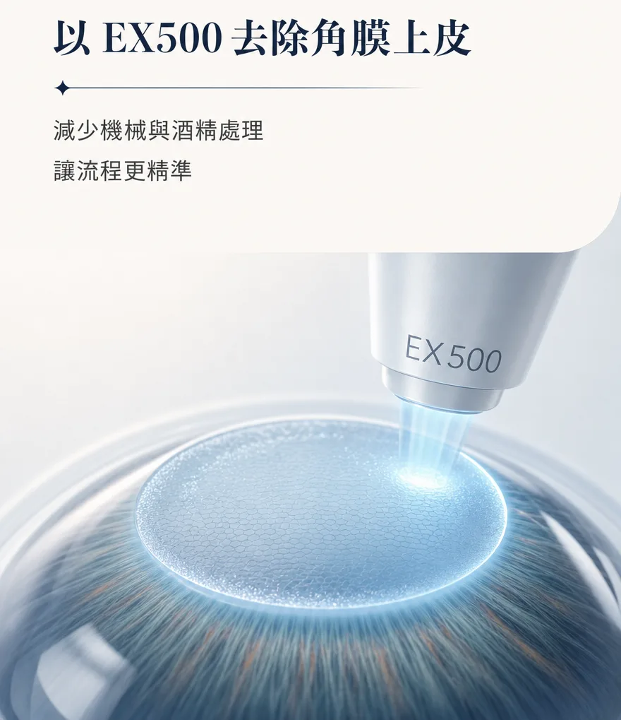 StreamLight 經上皮雷射(LASEK) — 以 EX500 去除角膜上皮 — 減少機械與酒精處理，讓流程更精準。